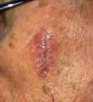 SRT-100 Radiation Before and After Case 70 After