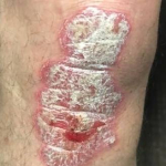 Psoriasis Before and After Case 27 Before