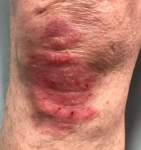 Psoriasis Before and After Case 27 After