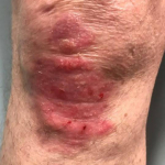 Psoriasis Before and After Case 27 After