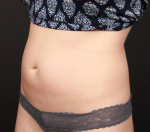 CoolSculpting<sup>®</sup> Before and After Case 15 Before