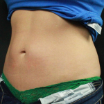 CoolSculpting<sup>®</sup> Before and After Case 15 After