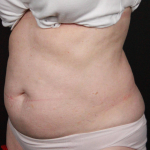 CoolSculpting<sup>®</sup> Before and After Case 16 Before