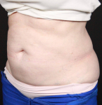 CoolSculpting<sup>®</sup> Before and After Case 16 After