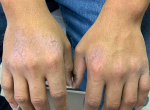 Eczema/ Atopic Dermatitis Before and After Case 12 Before