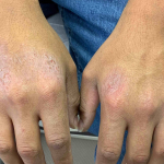 Eczema/ Atopic Dermatitis Before and After Case 12 Before