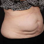CoolSculpting<sup>®</sup> Before and After Case 17 Before