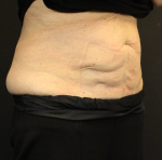 CoolSculpting<sup>®</sup> Before and After Case 17 After