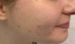 Acne Before and After Case 12 Before