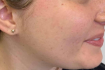 Acne Before and After Case 12 After