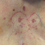 Skin Cancer Case Before and After 17 Before