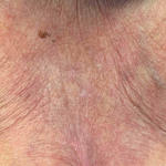Skin Cancer Case Before and After 17 After
