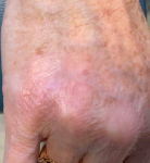 Skin Cancer Before and After Case 18 After