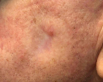 SRT-100 Radiation Before and After Case 77 After
