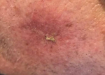 Skin Cancer Before and After Case 20 Before