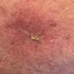 Skin Cancer Before and After Case 20 Before