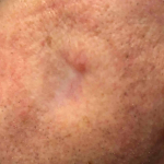 Skin Cancer Before and After Case 20 After