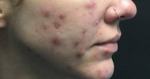 Acne Before and After Case 13 Before