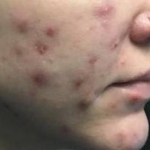 Acne Before and After Case 13 Before
