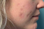 Acne Before and After Case 13 After