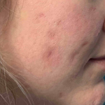Acne Before and After Case 13 After
