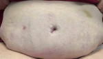 Eczema/ Atopic Dermatitis Before and After Case 14 After