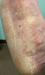 Eczema/ Atopic Dermatitis Before and After Case 16 Before