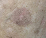 SRT-100 Radiation Before and After Case 88 After