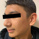Acne Before and After Case 14 Before