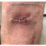 Skin Cancer Before and After Case 21 After