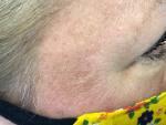 Skin Cancer Before and After Case 22 After