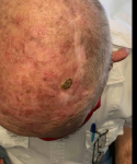 SRT-100 Radiation Before and After Case 95 Before