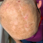 SRT-100 Radiation Before and After Case 95 After