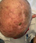 Skin Cancer Before and After Case 23 Before