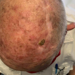 Skin Cancer Before and After Case 23 Before