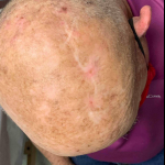 Skin Cancer Before and After Case 23 After