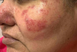 Rosacea Before And After Case 5 Before