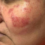 Rosacea Before And After Case 5 Before