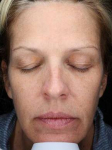 IPL-Photofacial/BBL Before and After Case 1 Before