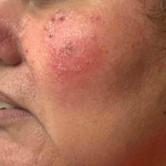 Rosacea Before And After Case 5 After