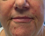 Rosacea Before And After Case 6 Before