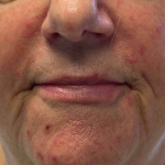 Rosacea Before And After Case 6 Before
