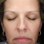 IPL-Photofacial/BBL Before and After Case 1 After