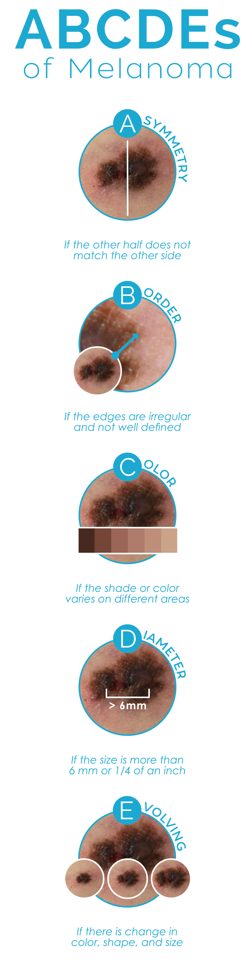 ABCDEs Melanoma