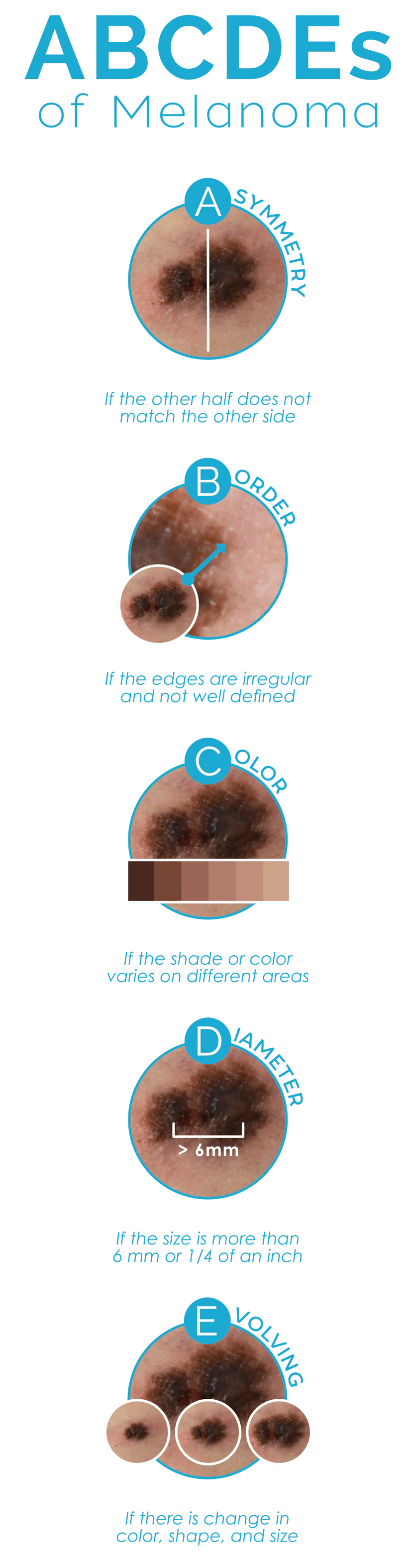 ABCDEs Melanoma