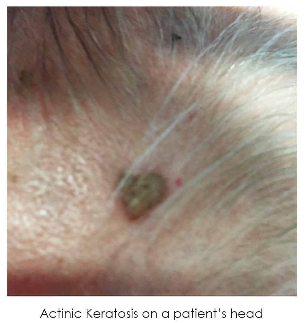 Actinic Keratosis on a patient's head