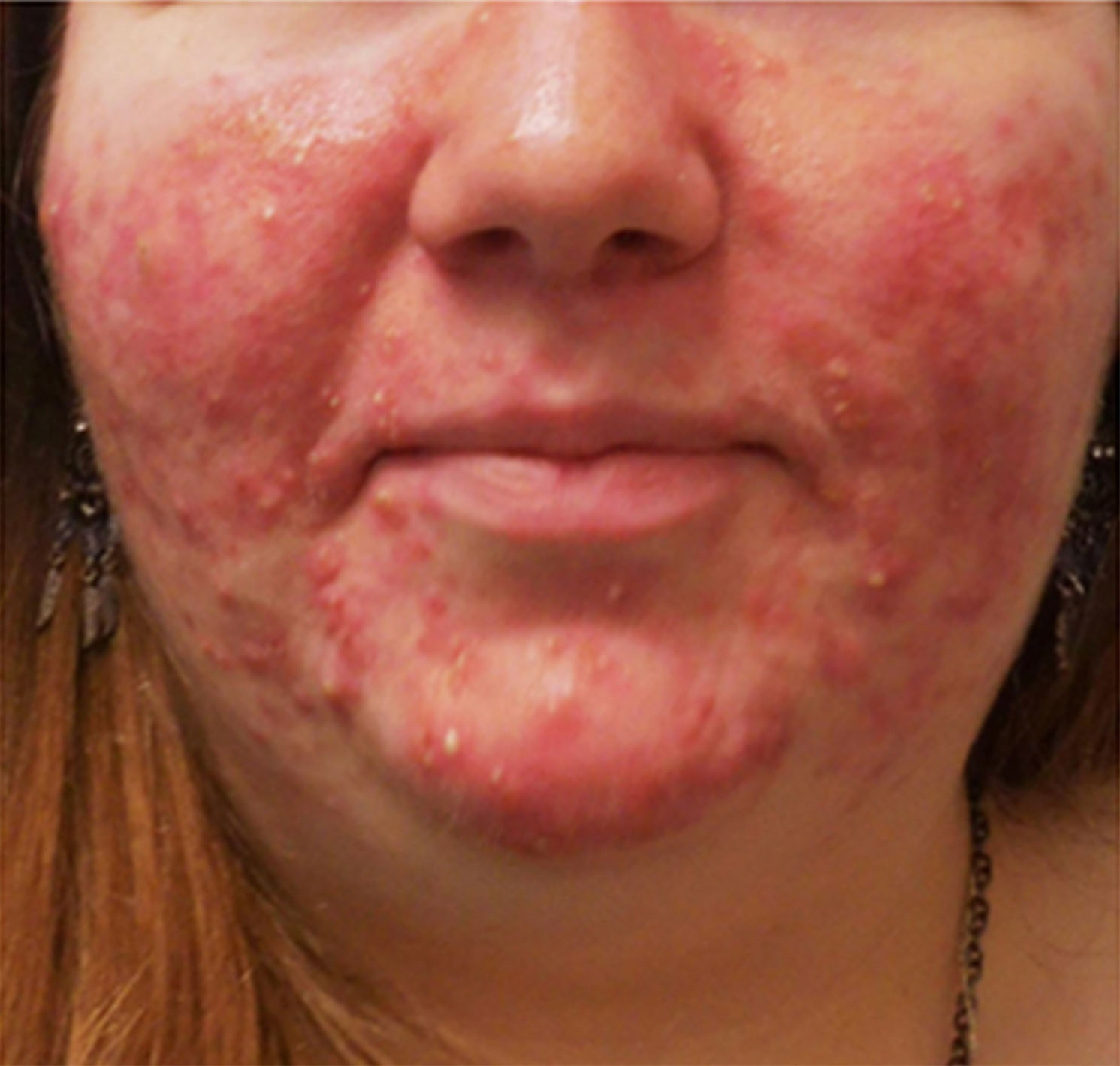 Acne Before