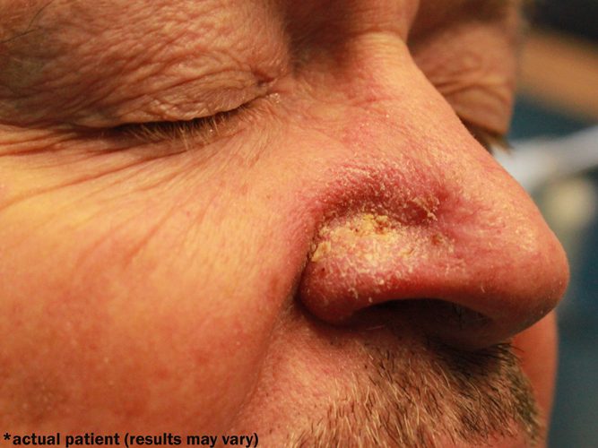 Basal Cell Carcinoma