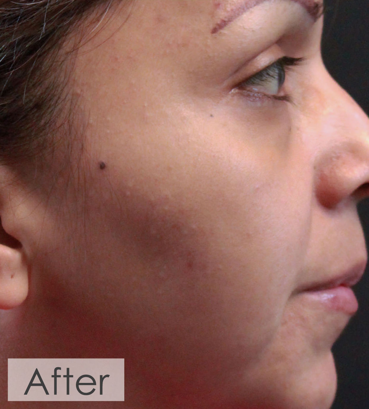 https://www.dermofficedallas.com/wp-content/uploads/2021/04/Chemical_Peel-after.jpg