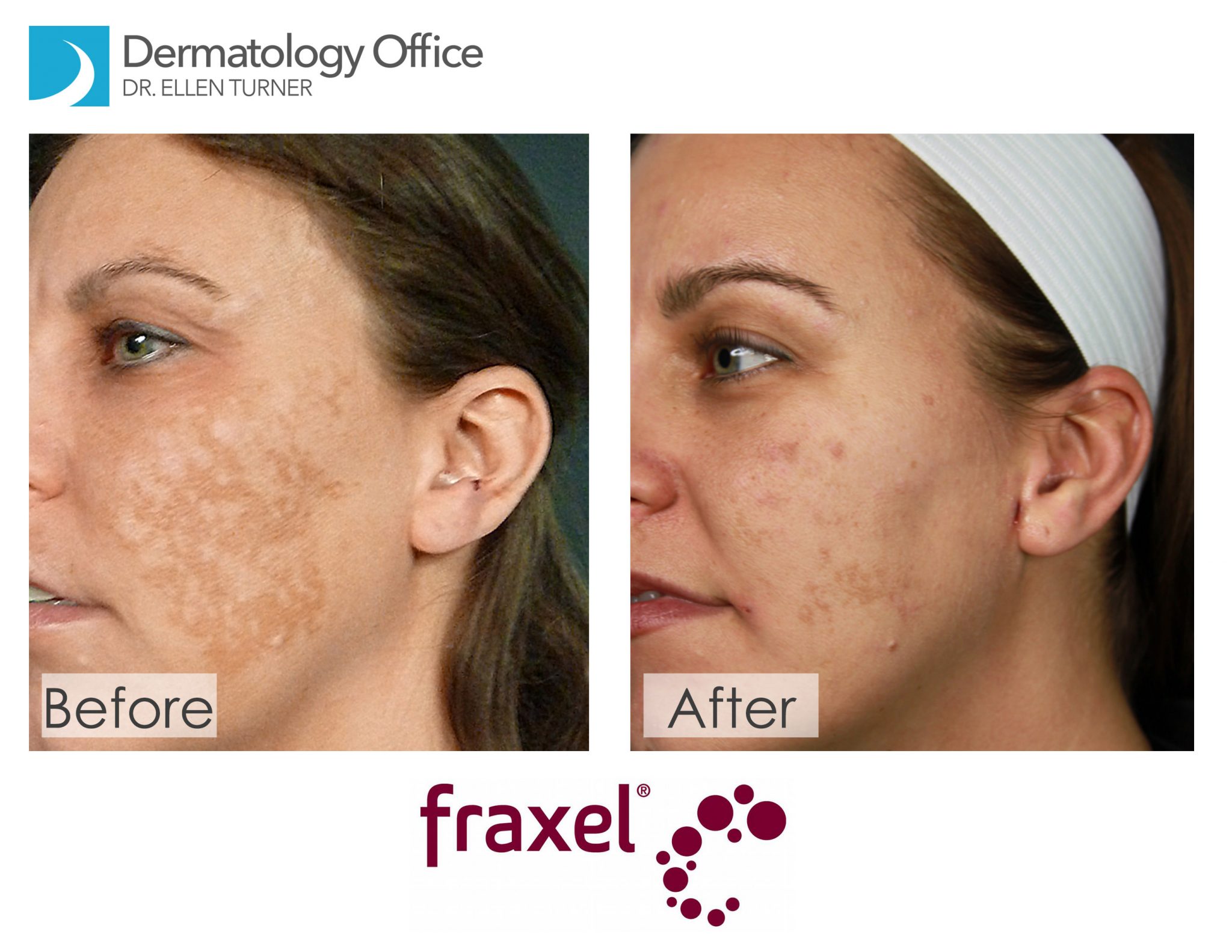 Laser Skin Resurfacing | Fraxel laser Dallas Area | Dr. Ellen Turner